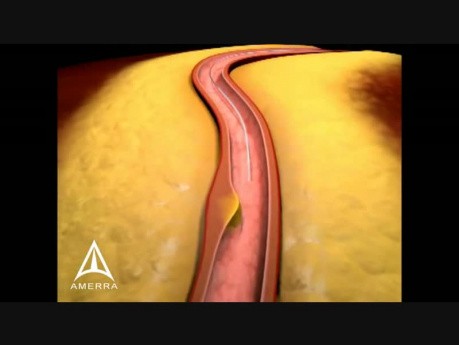 Arterial Stenting - 3D Medical Animation