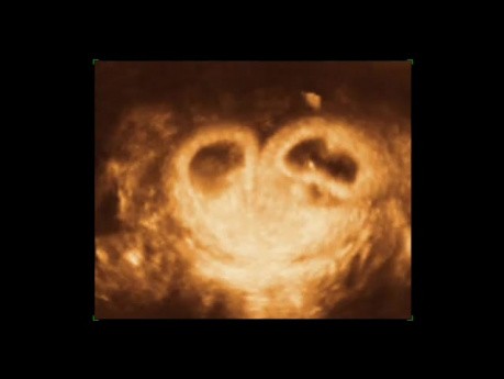 Imaging in Gynecology - 4D USG