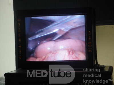 Gastric Ulcerated Adenocarcinoma of the Pre-pyloric Antrum (13 of 28)