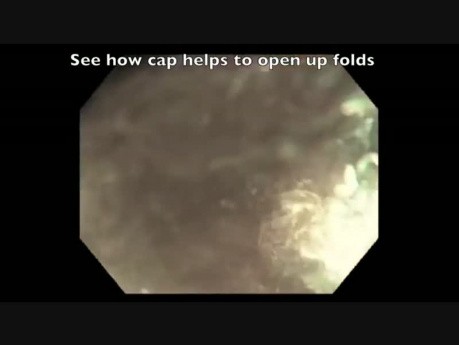 Colonoscopy Channel - Hidden Serrated Polyp 