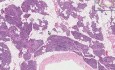 Fatty infiltration - Histopathology - Pancreas
