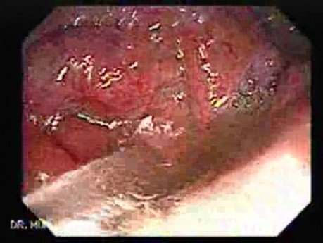 Severe case of Ischemic Colitis (8 of 19)