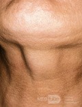 Thyroglossal Duct  Cyst During Swallowing