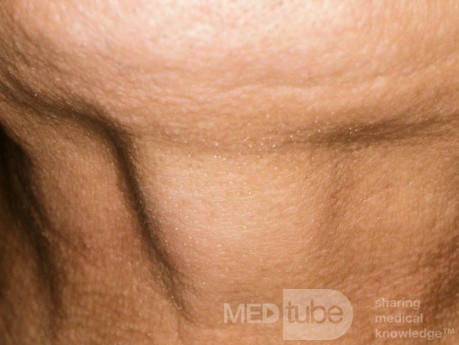 Thyroglossal Duct  Cyst During Swallowing