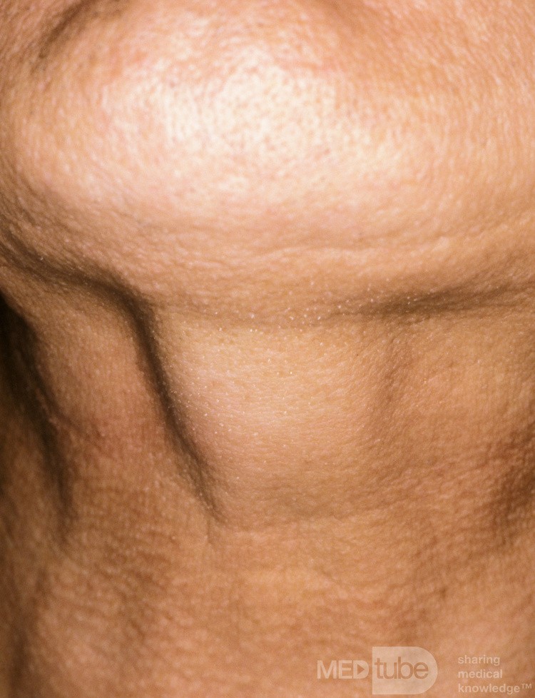 Thyroglossal Duct  Cyst During Swallowing
