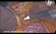Laparoscopic Cholecystectomy in Cirrhotic Patient