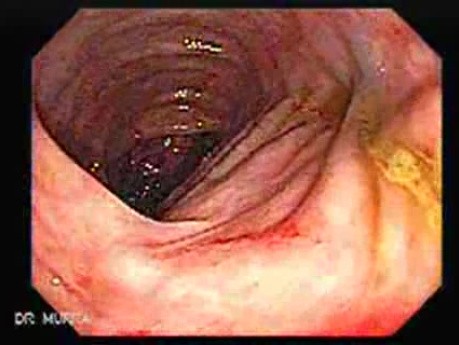 Consecutive colonoscopy with dilation was carried out (9 of 15)
