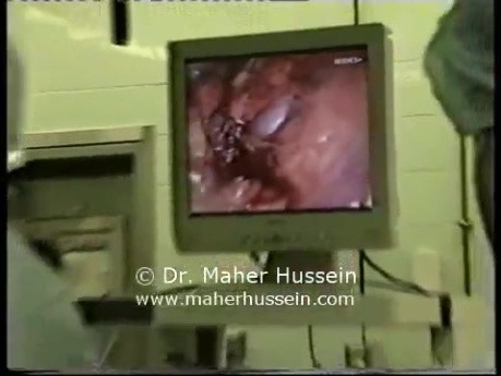 Live Surgery At AUB - Part 4