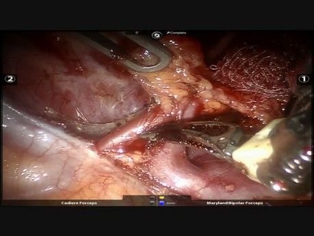 Mediastinal Tumor Resection by Robotic Surgery