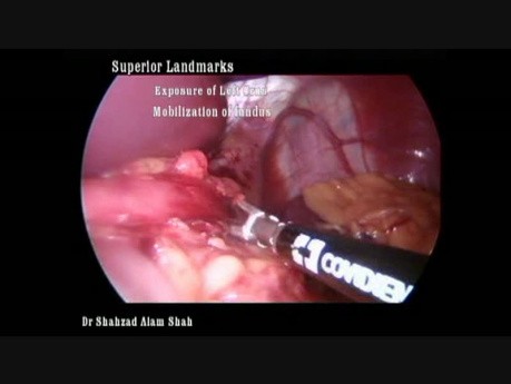 Sleeve Gastrectomy - How I Do It
