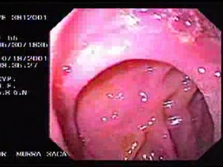 Ulcer at Anastomosis of a Billorth II Gastrectomy (3 of 4)