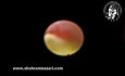 A Common Bile Duct Stone as we see during Laparoscopic Choledochoscopy