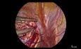 Laparoscopic Myomectomy (With Voice Over)
