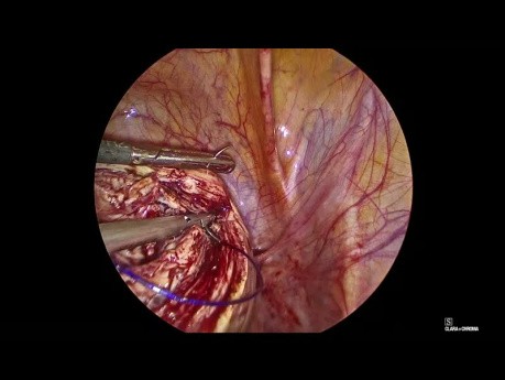 Laparoscopic Myomectomy (With Voice Over)