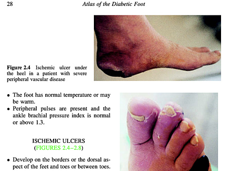 Atlas of Diabetic Foot