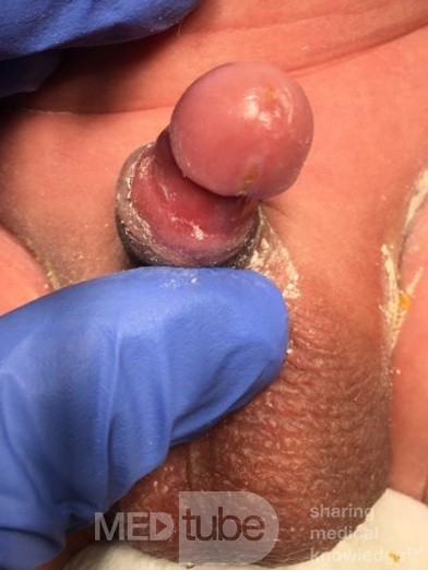 Post Circumcision Platibell Paraphemosis- Post Removal of Platibell