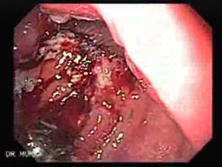 Recurrent Gastric Adenocarcinoma - Endoscopy (4 of 4)