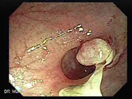 Polyp Inside Of A Diverticulum (7 of 12)
