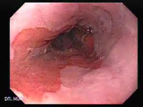 Barrett Esophagus - endoscopic view  (8 of 9)