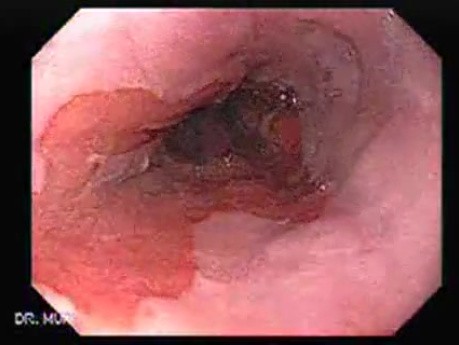 Barrett Esophagus - endoscopic view  (8 of 9)