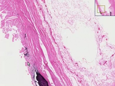 Atherosclerosis - Histopathology - Aorta