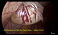Endobag for Dermoid Cystectomy