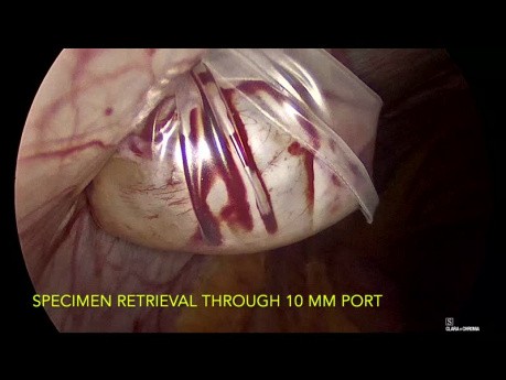 Endobag for Dermoid Cystectomy