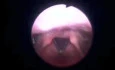 Functional Voice Disorder 