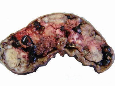 Gallbladder Adenocarcinoma and litiasis (2 of 13)