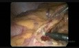 Laparoscopic Left Hemicolectomy for Obstructed Colon Cancer