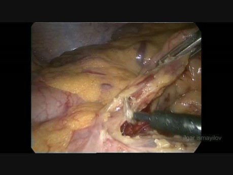 Laparoscopic Left Hemicolectomy for Obstructed Colon Cancer
