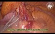 Laparoscopic Appendectomy Base Stapling