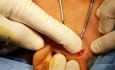 Preauricular Incision for Emenictomy