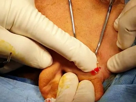 Preauricular Incision for Emenictomy