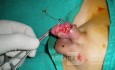 Penis Injury  Intra-Operative Photo