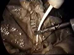 Laparoscopic Gallbladder Surgery