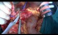 Distal Pancreatectomy for Neuroendocrine Tumor