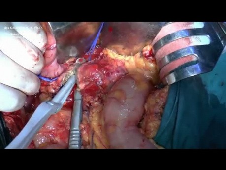 Distal Pancreatectomy for Neuroendocrine Tumor