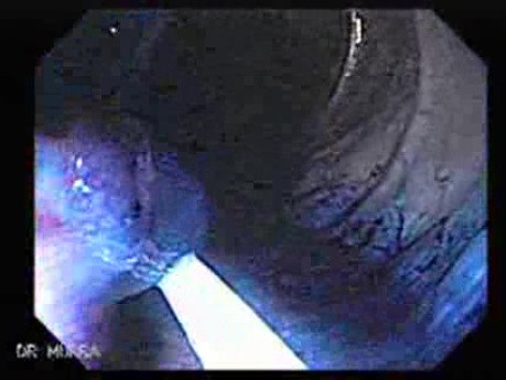 Juvenile Non Familial Polyposis of the Colon (31 of 37)