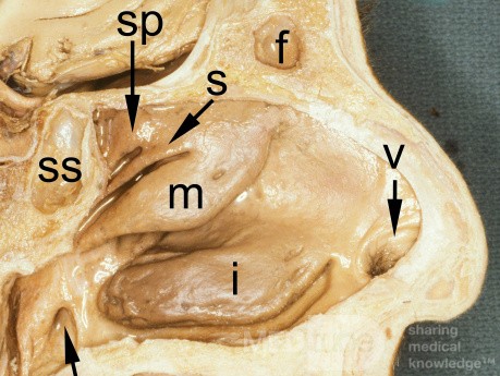 The Lateral Wall of the Nose Labelled [Cadaveric Specimen]