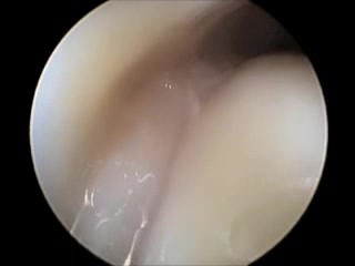 Arthroscopy Of The Scapulohumeral Joint Using Air Insufflation