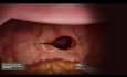 Laparoscopic Hysterectomy - Vaginal Cuff Closure Animation with Unidirectional Quill® Barbed Suture