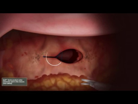 Laparoscopic Hysterectomy - Vaginal Cuff Closure Animation with Unidirectional Quill® Barbed Suture