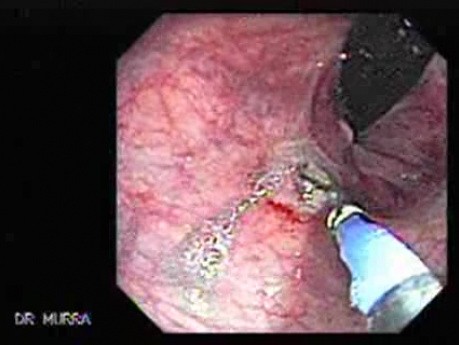 Rectal Dieulafoy’s Lesion (2 of 4)