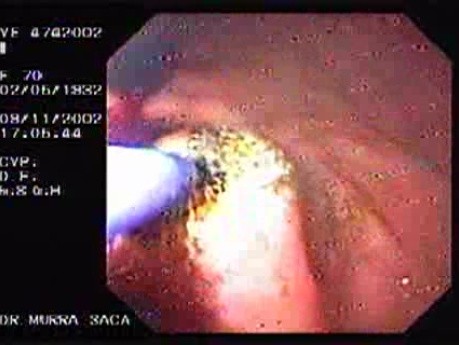 Dieulafoy´s Lesion (Exulceratio Simplex) (7 of 11)