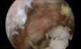 Sinking Myoma