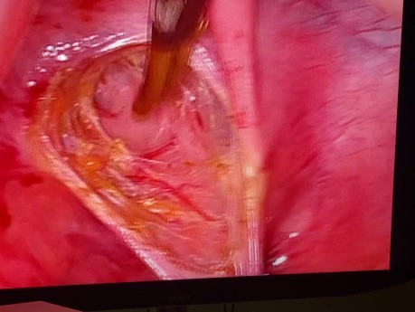 Cervicovagainal Agenesis