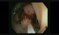 Large Splenic Flexure Polyps, Polypectomy