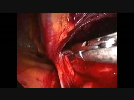 Laparoscopic Inguinal Hernioplasty With 3D MAX Mesh