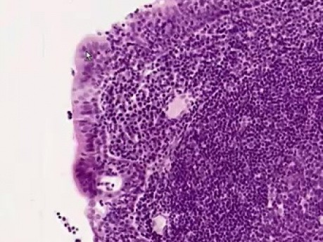 Pharyngeal Tonsil - Histology